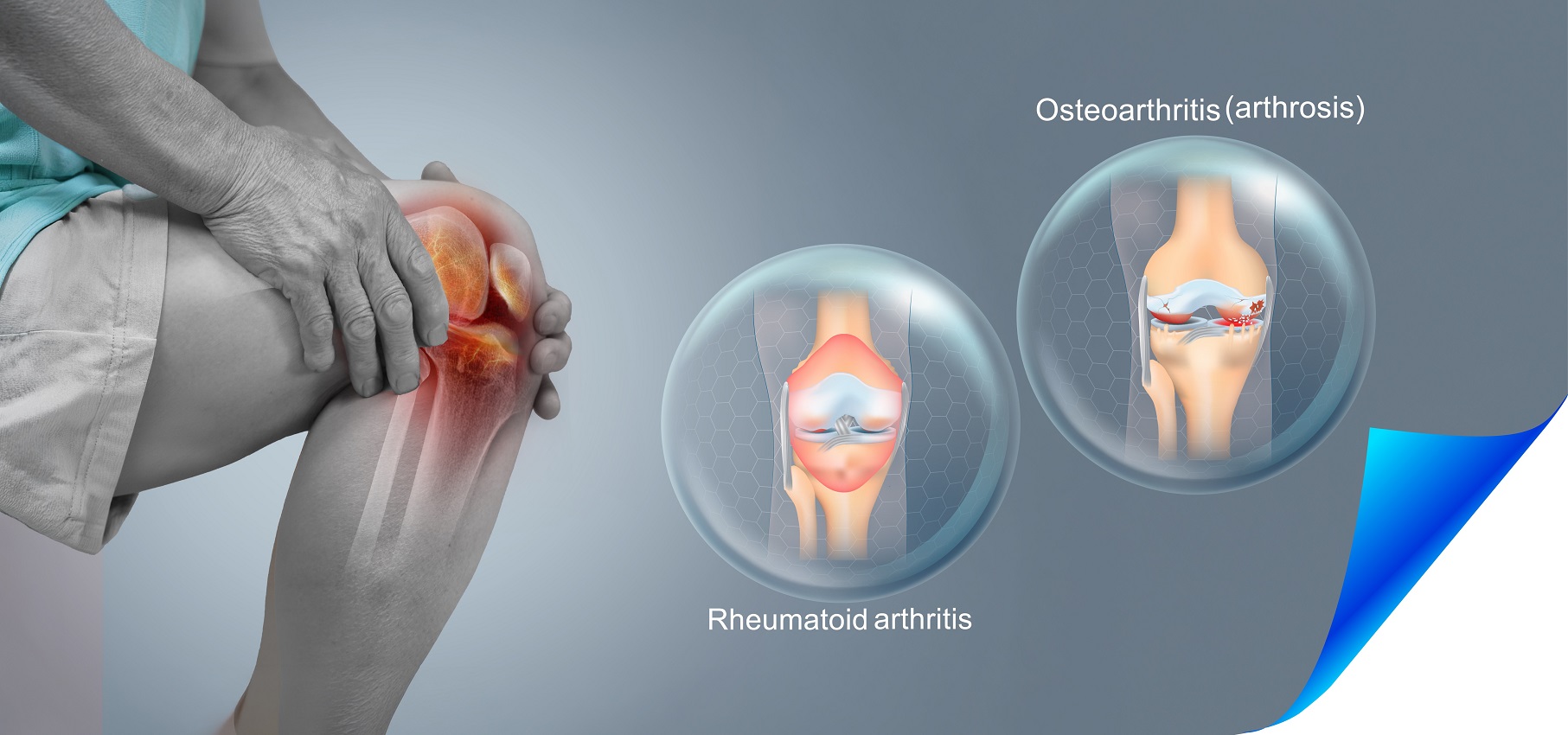 Osteoarthritis vs Rheumatoid Arthritis of the Knee