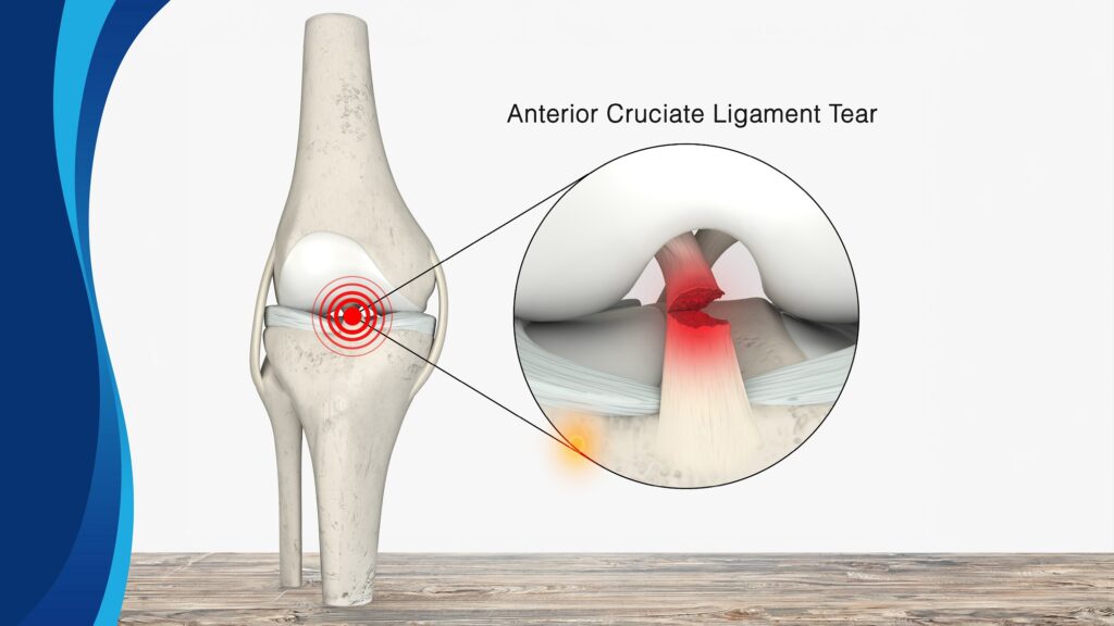 Partial Ligament Tear in the Knee