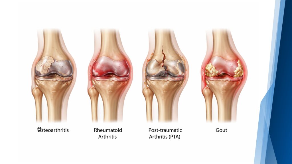 Types of arthritis occur in your knee