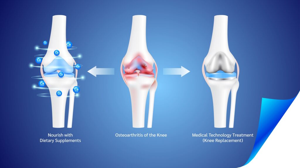 What is Osteoarthritis? What is Osteoarthritis?