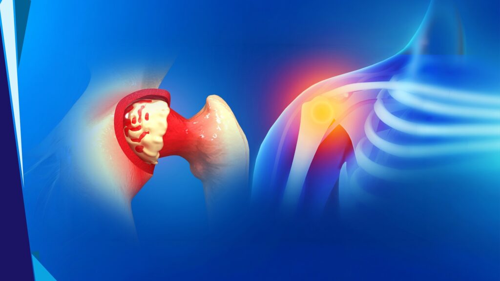 Common Rotator Cuff Tear Symptoms Common Rotator Cuff Tear Symptoms