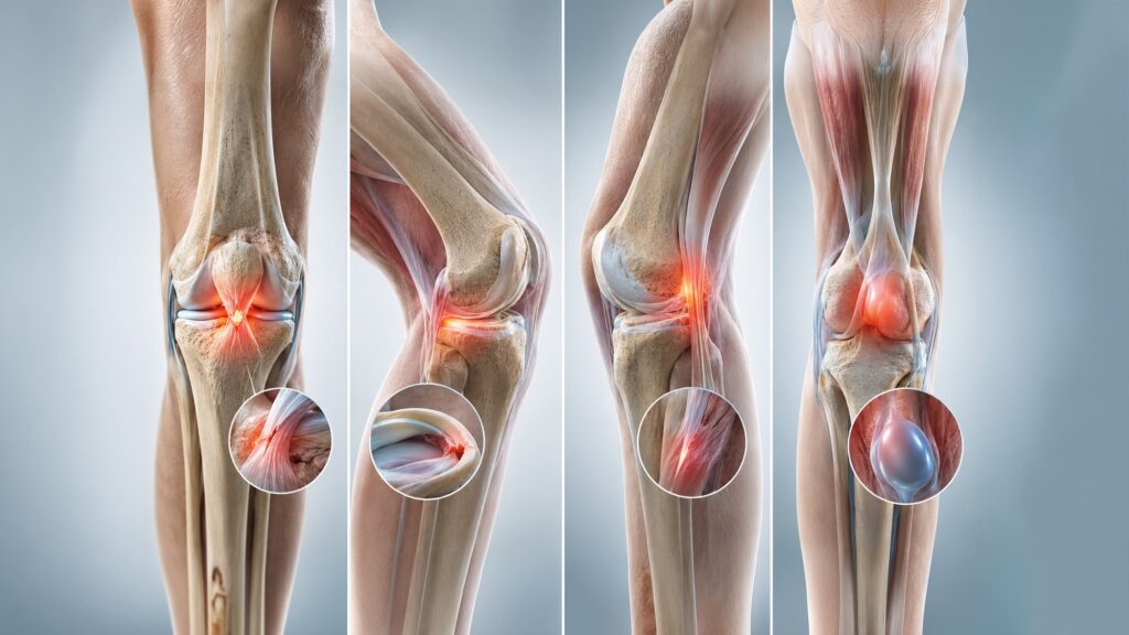 Medical illustration showing knee pain causes by location with highlighted front, side, and back pain areas.